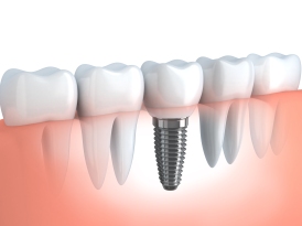 bigstock-Dental-Implant-51820759