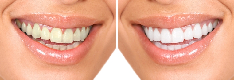 Brampton Teeth Whitening, Dentists in Brampton, Dentists, Healthy Smiles,
